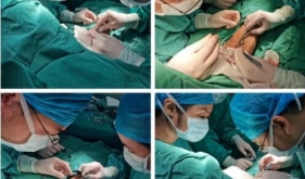 新技术|桂医附院肾内科血管通路团队成功开展人工血管内瘘术