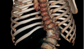 9岁男孩脊柱侧凸明显，桂医附院脊柱外科矫形手术助其挺直腰杆