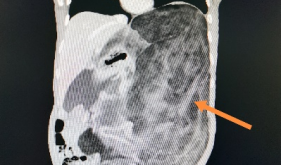 罕见，桂林一男子腹腔长了个20斤的巨大肿瘤……