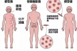 桂医附院首例单倍体相合异基因造血干细胞移植成功