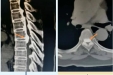 【广西首例】这例高难度、高风险手术，脊柱、骨病外科在两个1厘米小切口内完成