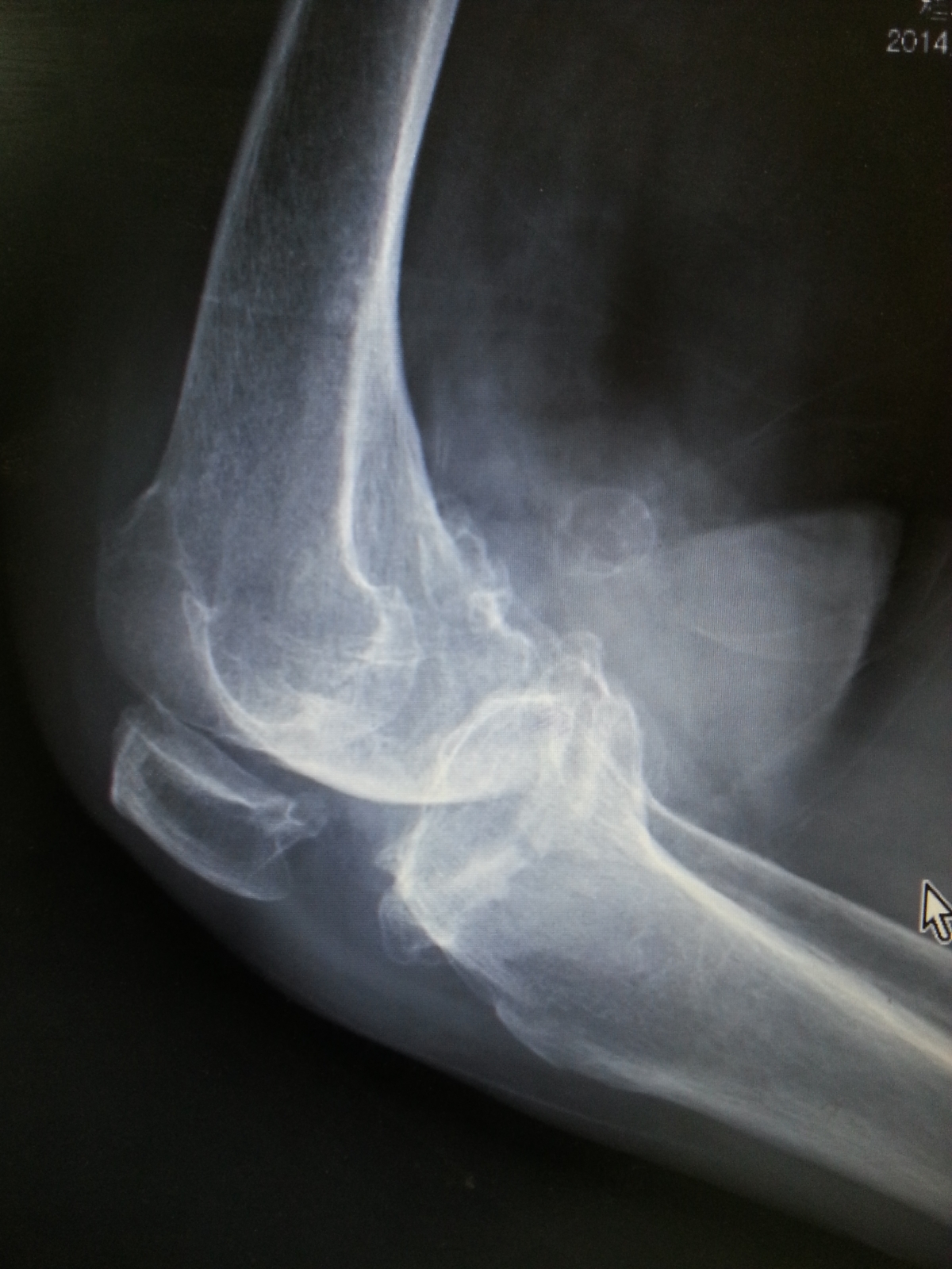 人工膝关节置换术