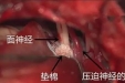 左眼跳“财”，右眼跳“灾”？别信，神经外科提醒，这可能是一种病