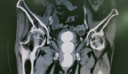 一七旬老人膀胱里发现三颗“舍利子”，真相是……