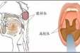 打鼾的孩子睡得深？别闹了，那是病