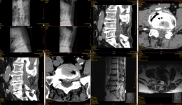 脊柱外科1cm微创切口治愈89岁老干部腰椎间盘突出症