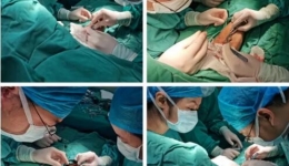 新技术|桂医附院肾内科血管通路团队成功开展人工血管内瘘术