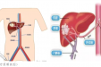 【精湛医术】治疗晚期肝癌的利器 ——血管介入科HAIC治疗