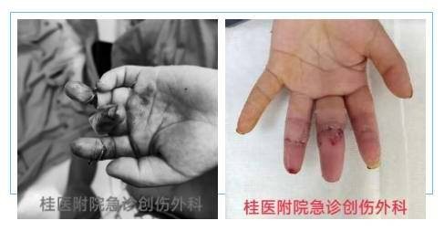 桂林多位小孩意外断指紧急送医，家长记住这几点可避免手指残疾