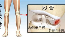 半月板损伤膝关节疼痛5个月，桂医附院中医康复技术帮助患者解除疼痛