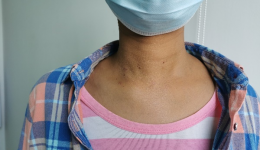 【精湛医术】这家医院给患者切除甲状旁腺，竟做到术后颈部无痕