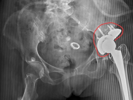 脊柱骨病外科为一小儿麻痹症合并先髋股骨头坏死患者实施全髋关节置换手术