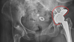脊柱骨病外科为一小儿麻痹症合并先髋股骨头坏死患者实施全髋关节置换手术