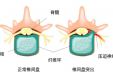 椎间盘突出症发作疼痛难耐，桂医附院康复治疗部专家妙手回春缓解病痛