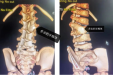 先天性半椎体脊柱畸形手术要趁早，脊柱外科医生成功为一3岁患儿进行脊柱矫形