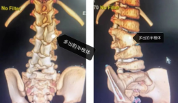 先天性半椎体脊柱畸形手术要趁早，脊柱外科医生成功为一3岁患儿进行脊柱矫形
