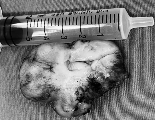 【小儿腹痛不可忽视】小儿外科采用单孔腹腔镜技术为患儿解除病痛