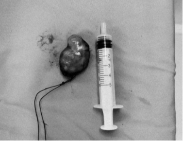 桂林一阿姨颈椎肿瘤导致无法行走，桂医附院实施高难度手术助其恢复