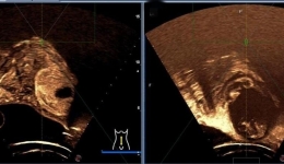有子宫肌瘤、腺肌病又想怀孕？一附院专家：优选这种“无创”治疗方案